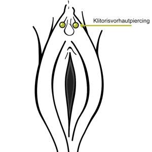 klitorispiercing|Klitorisvorhautpiercing – Wikipedia.